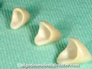 Dental Crowns in Los Algodones