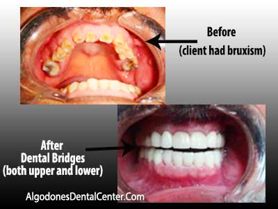 Before-and-After Dental Bridge