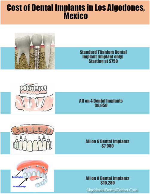 Dental Implants Cost Los Algodones - Infographic