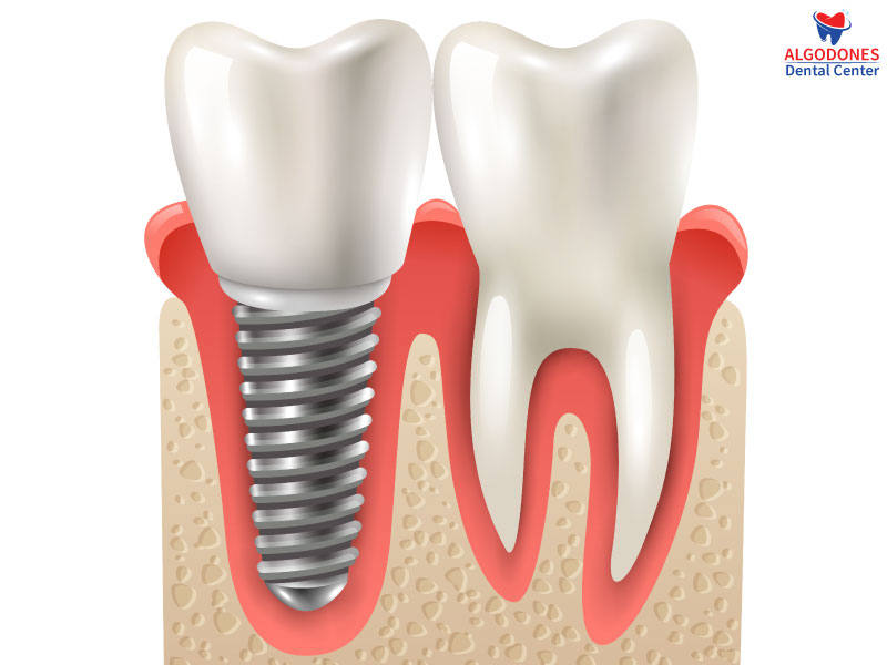 Dental implant in Los Algodones