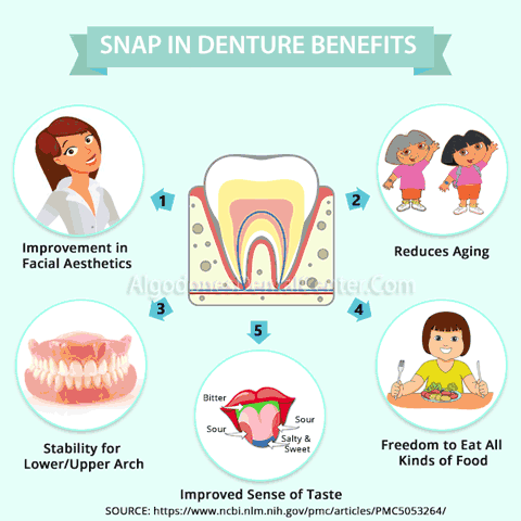 Snap In Denture Benefits