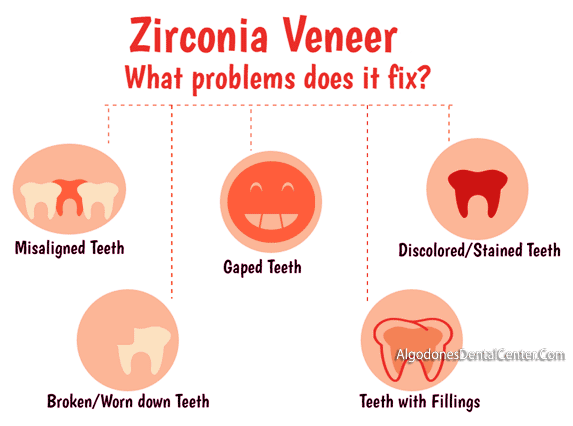Zirconia Veneers - Infographic