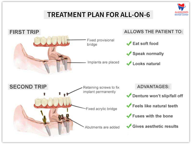 Timeline for All on 6 Implants in Algodones