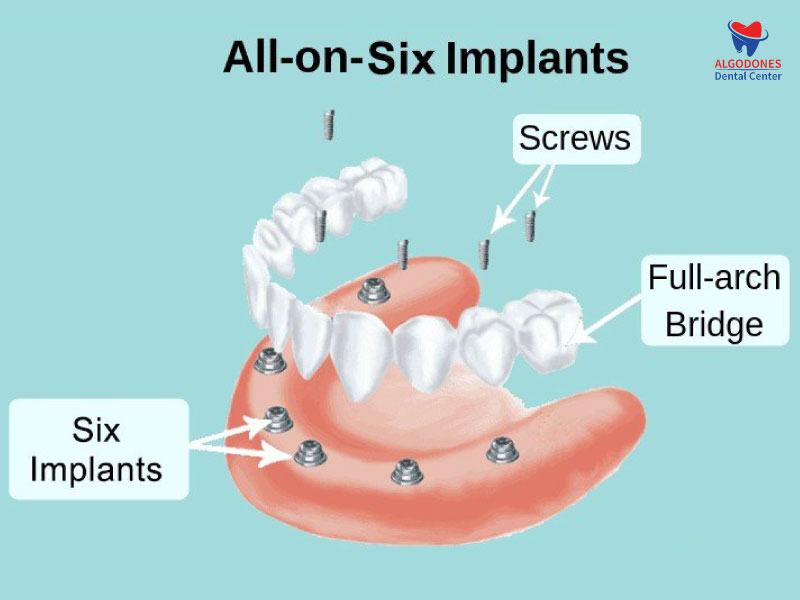 All on 6 Implants in Algodones