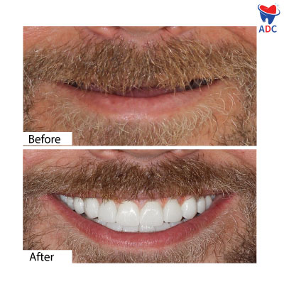 Full Mouth Restoration in Los Algodones | Before & After