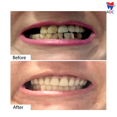 Full Mouth Restoration in Los Algodones | Before & After