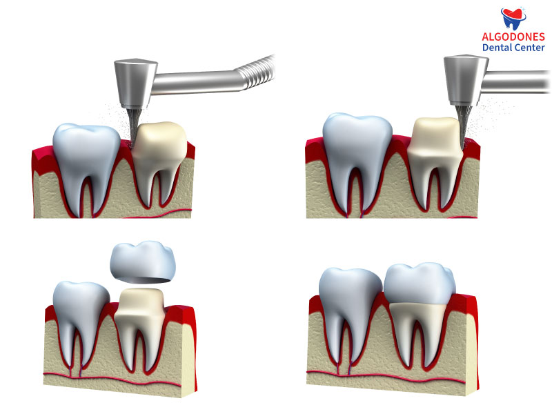 PFM crown procedure in Los Algodones