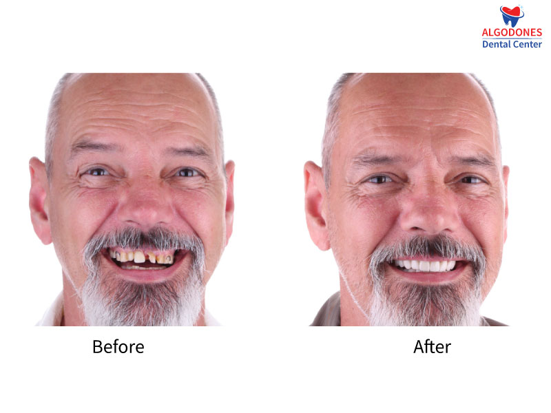 Affordable Zirconia Crowns Near Yuma, Arizona: before and after