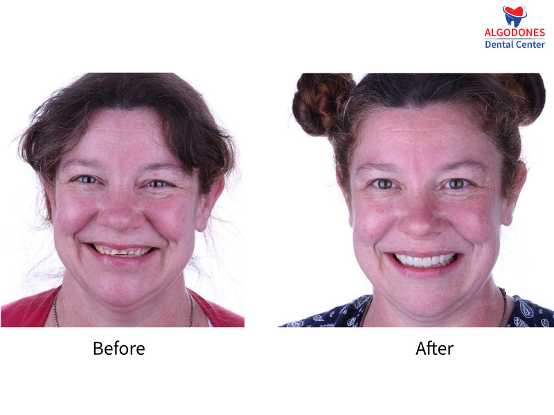Before and After Getting Affordable Zirconia Crowns Near Yuma, Arizona