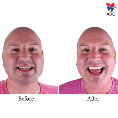 Dental-crowns-in-los-algodones- before and after image
