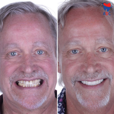 Dental-crowns-in-los-algodones before and after image