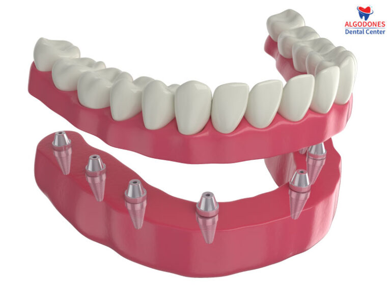 Implant Supported Dentures in Los Algodones, Mexico