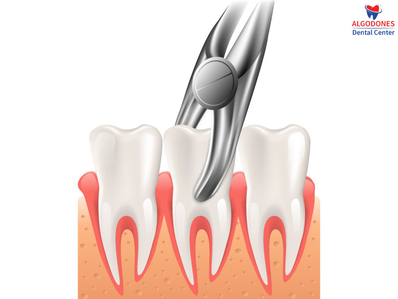 Removal of tooth