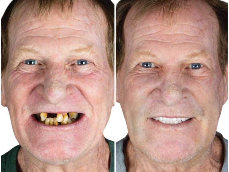 Before and after: All-on-4 Dental Implants in Los Algodones