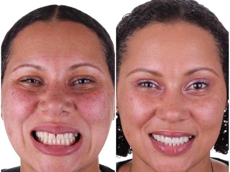 Before and after: Dental Crowns in Los Algodones