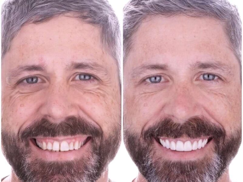 Before and after: Dental Veneers in Los Algodones