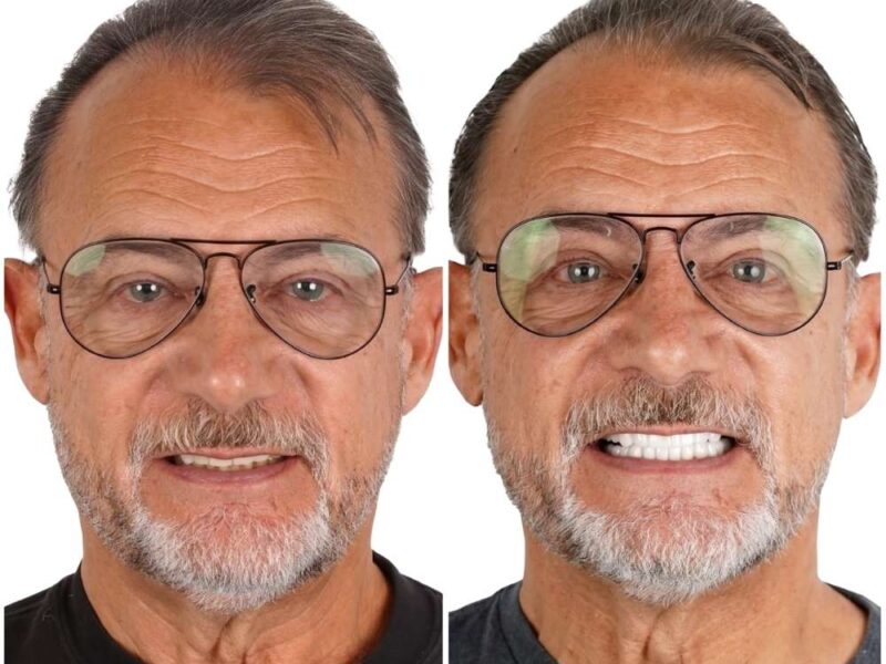 Before and after: Dental Veneers in Los Algodones