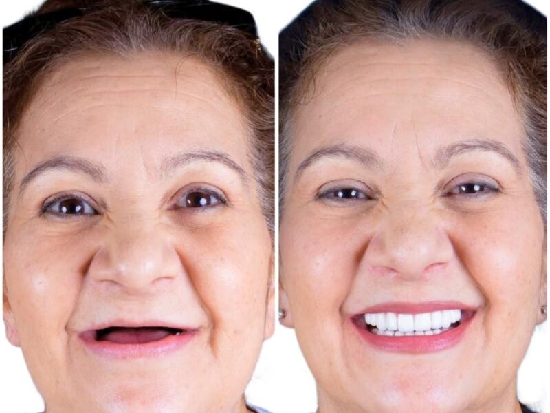 Before and after: Full Mouth Restoration in Los Algodones