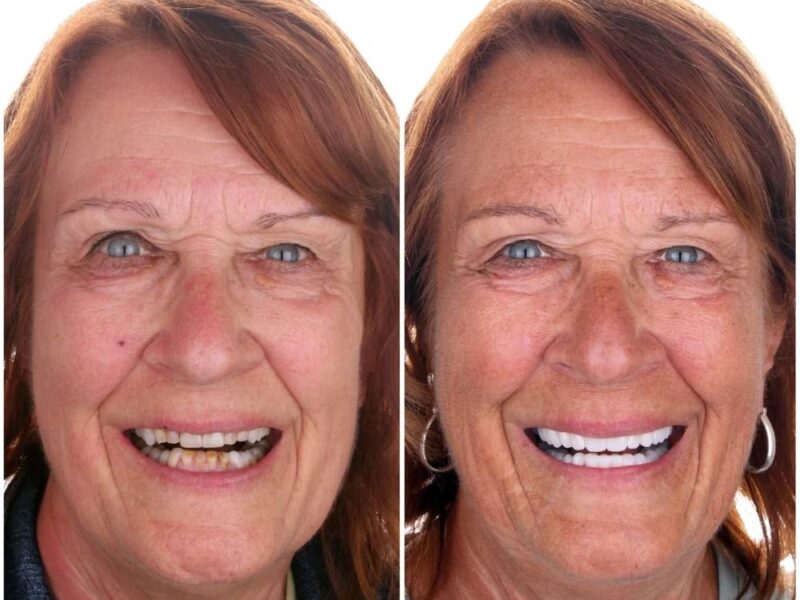Before and after: Full Mouth Implants in Los Algodones