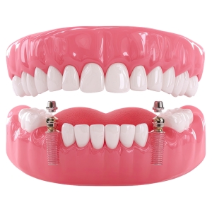 Dental Implants