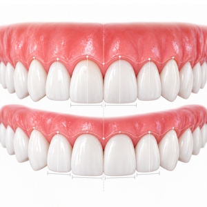 Smile Design