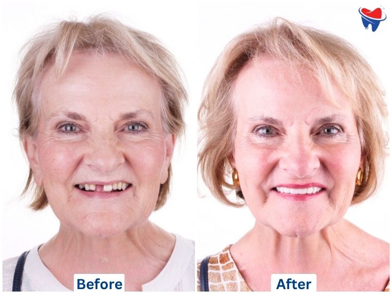 Zirconia Crown — after