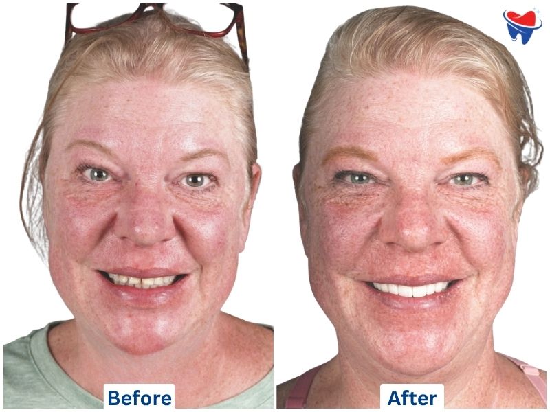 Root Canal, Post/Core Build-Up & Zirconia Crown — after