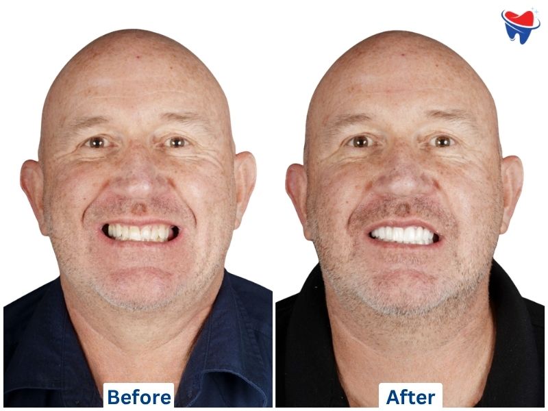 Single & Multiple Tooth Implants, Zirconia Crown — after