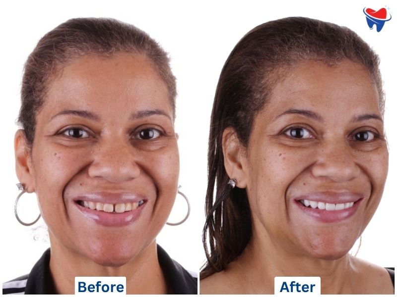 Straumann BLX Implant & Zirconia Crown — after