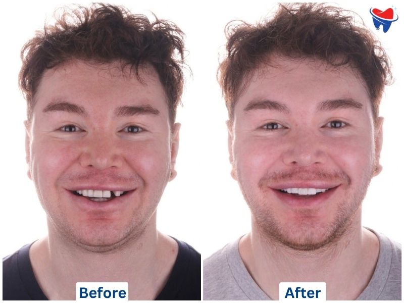 Regular Teeth Cleaning, Straumann BLX Implant, Bone Graft & Zirconia Crown — after